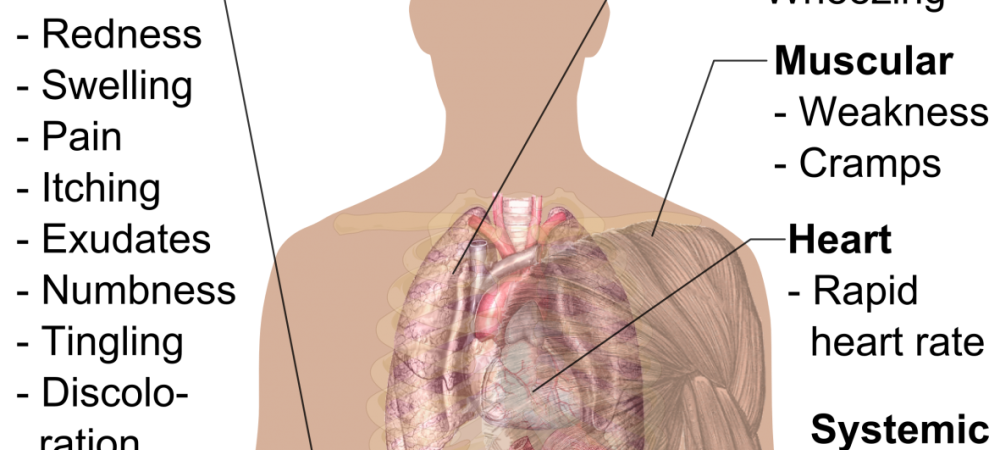 symptoms of a spider bite infographic