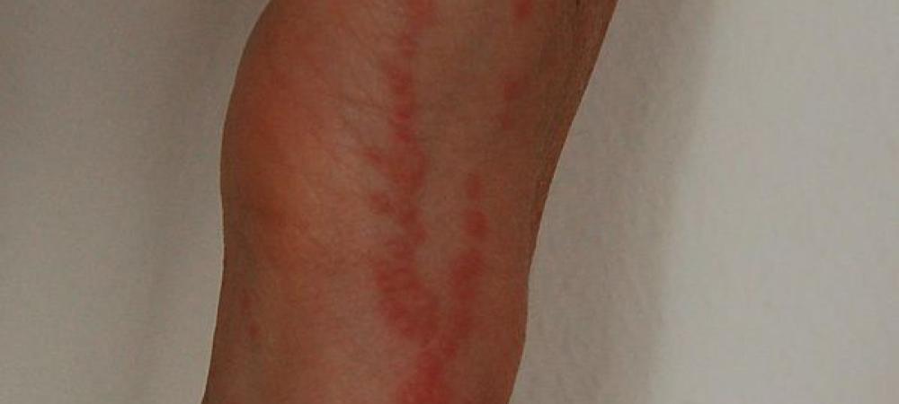 Bed on sale bug bites