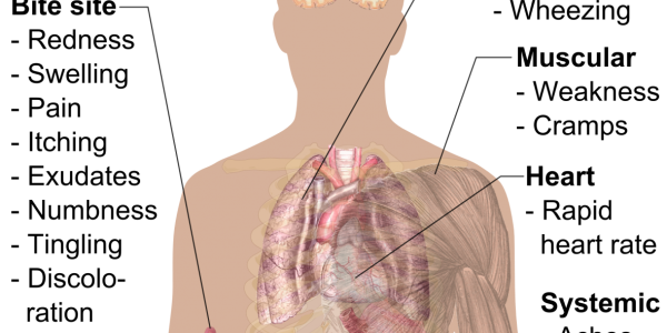 symptoms of a spider bite infographic